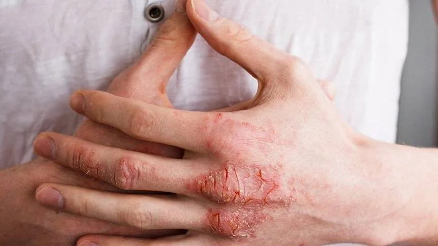 Atopik Dermatit nedir? Atopik Dermatit kimlerde görülüyor?