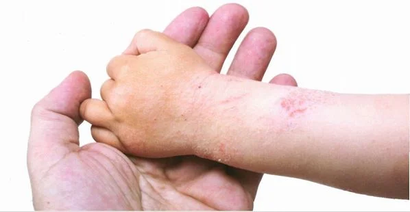Alerji nedir? Alerji belirtileri nelerdir? Alerji tedavisi nasıldır?