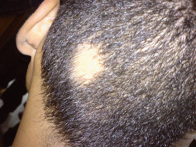 Saçkıran Hastalığı - Alopesi Areata
