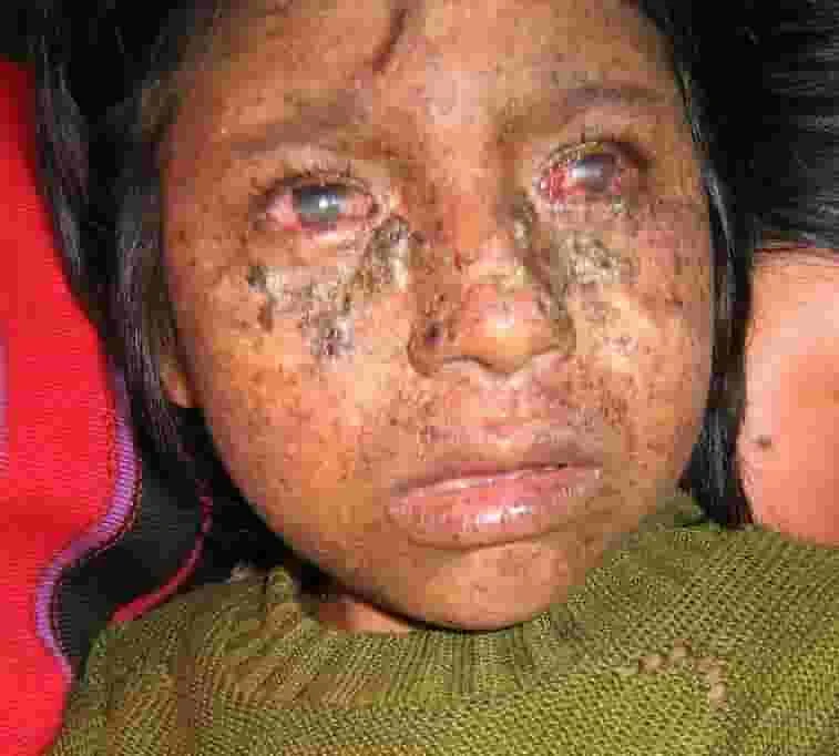 Güneşe Çıkamama Hastalığı - Xeroderma Pigmentosum