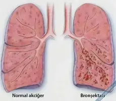 bronsektazi1.webp