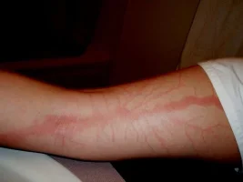 lichtenberg-figurleri-5.webp