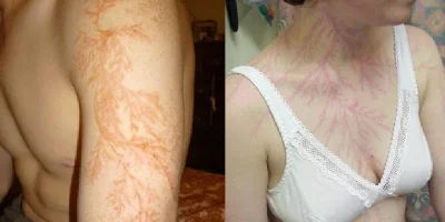 lichtenberg-figurleri-1.webp
