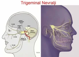 Delirten hastalık ( trigeminal nevralji ) nedir?