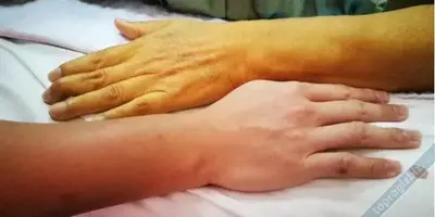 Sarılık nedir? Türleri nelerdir , Tedavisi nasıldır?