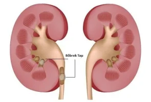 Böbrek taşı nedir? Böbrek taşı nasıl düşer? Böbrek ağrısına  ne  iyi gelir?