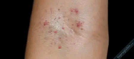 Peteşi Nedir? Nedenleri Belirtileri ve Tedavisi