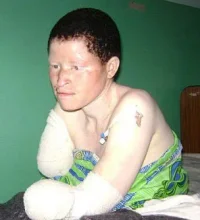 albino11_topragizbizcom_zpsd5bb5acb.webp