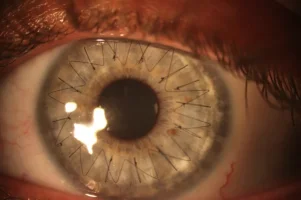 cornea_zpsprn3rskx.webp